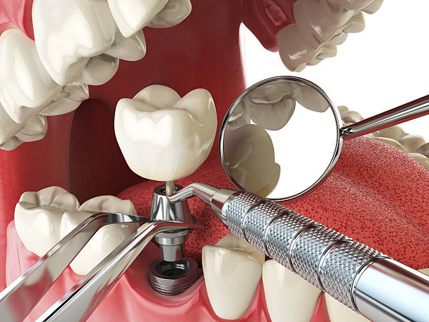 Best Emergency Dental Extractions in Brisbane, CA
